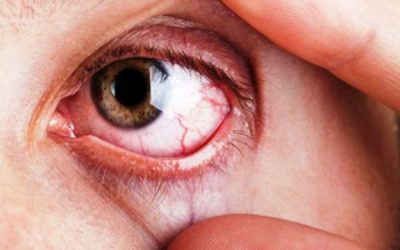 Glaucoma: lo que tenés que saber