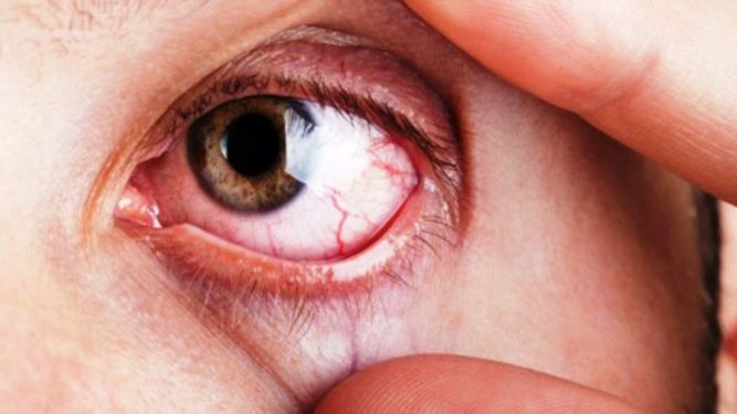 Glaucoma: lo que tenés que saber